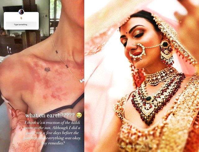 Priyanka Chopra's bhabhi Neelam Upadhyaya suffers burns on her skin