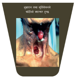 Nepal leads the world with largest pictorial health warnings on all tobacco products